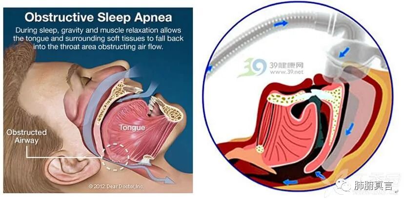 呼吸机f指什么呼吸机名词解释（三）_https://www.jmylbn.com_新闻资讯_第30张