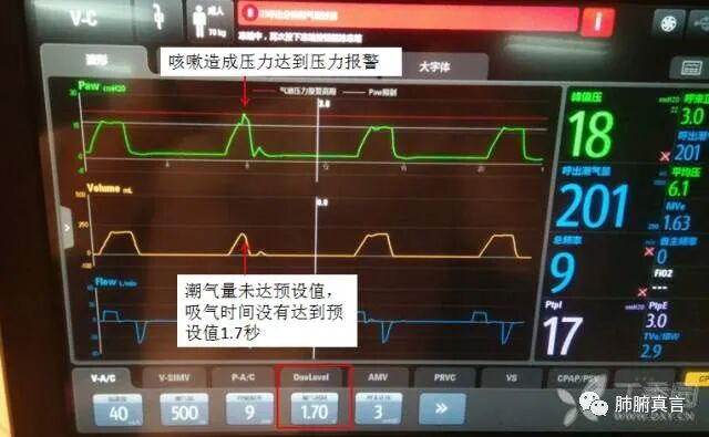呼吸机f指什么呼吸机名词解释（三）_https://www.jmylbn.com_新闻资讯_第11张