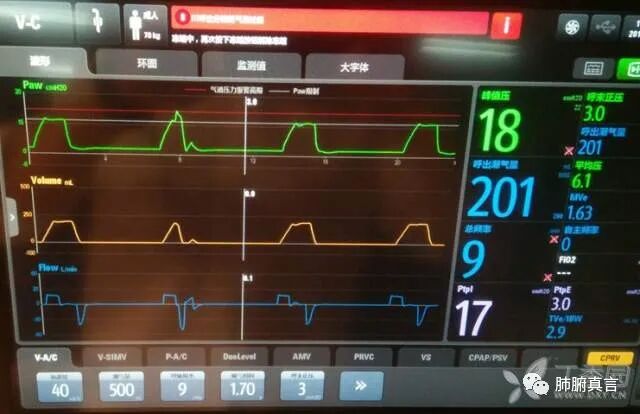 呼吸机f指什么呼吸机名词解释（三）_https://www.jmylbn.com_新闻资讯_第7张