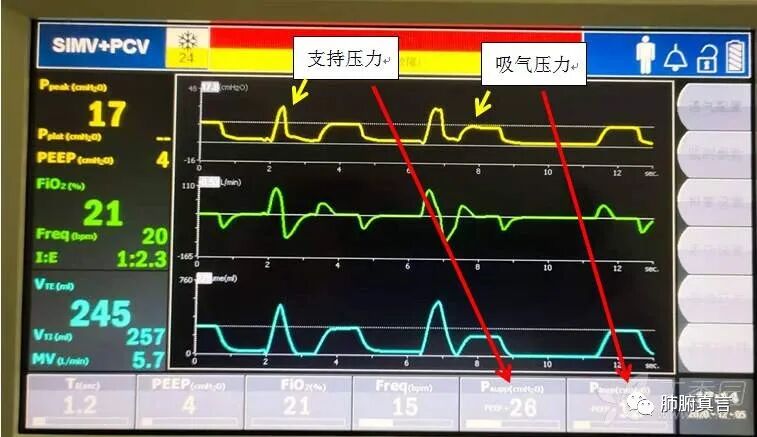 呼吸机f指什么呼吸机名词解释（三）_https://www.jmylbn.com_新闻资讯_第41张