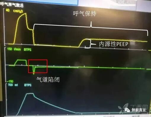 呼吸机f指什么呼吸机名词解释（三）_https://www.jmylbn.com_新闻资讯_第18张