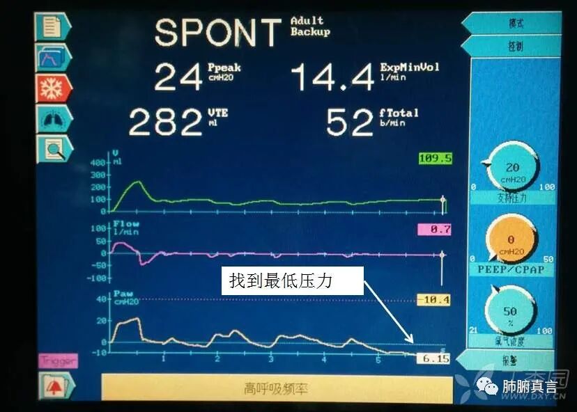 呼吸机f指什么呼吸机名词解释（三）_https://www.jmylbn.com_新闻资讯_第24张
