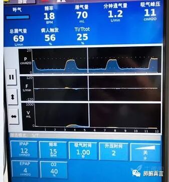 呼吸机f指什么呼吸机名词解释（三）_https://www.jmylbn.com_新闻资讯_第32张