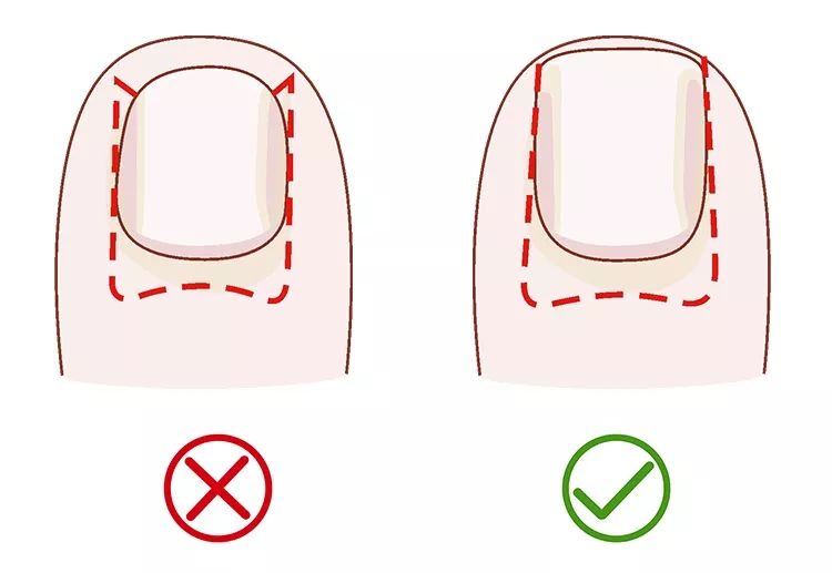 正確方法是,把指甲的邊緣修剪成直線,再把尖角和邊緣磨圓滑.