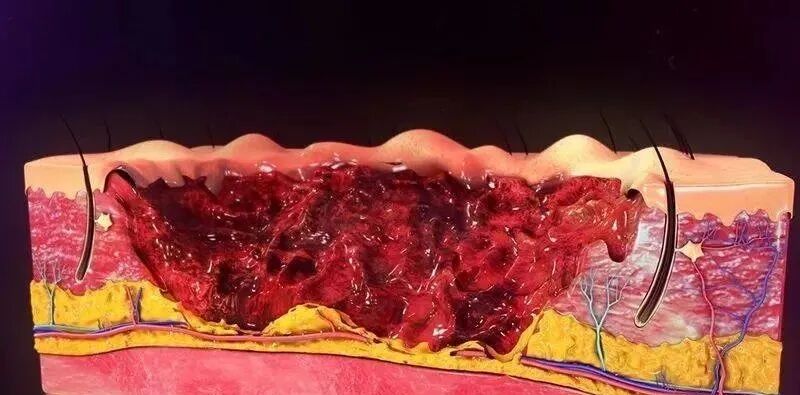 什么手术属无菌创口临床外科常见伤口处理相关知识，了解一下-上海聚慕医疗器械有限公司