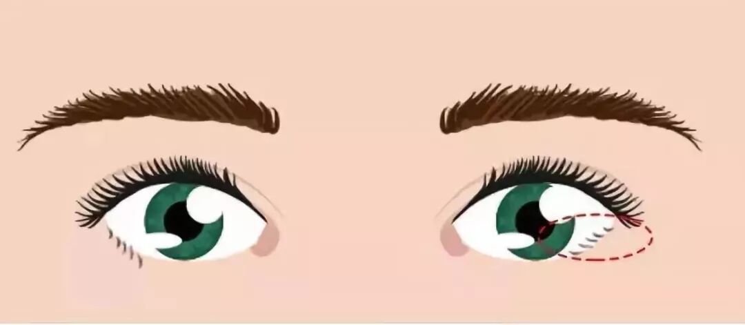 儿童倒睫的常见表现及危害，倒睫如何处理？