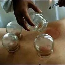 拔火罐的4种手法及正确的操作方法