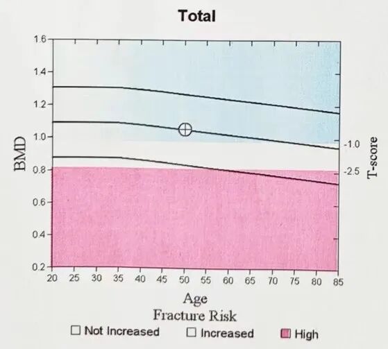 骨密度bmd是什么【药说】如何读懂DXA骨密度检查报告单，正确预防骨质疏松？_https://www.jmylbn.com_新闻资讯_第6张
