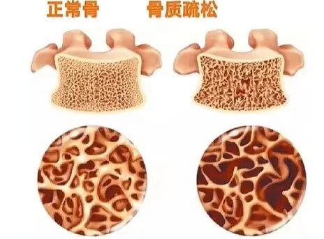 骨密度bmd是什么【药说】如何读懂DXA骨密度检查报告单，正确预防骨质疏松？_https://www.jmylbn.com_新闻资讯_第2张