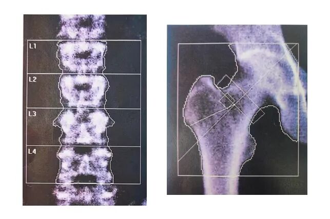 骨密度bmd是什么【药说】如何读懂DXA骨密度检查报告单，正确预防骨质疏松？_https://www.jmylbn.com_新闻资讯_第4张