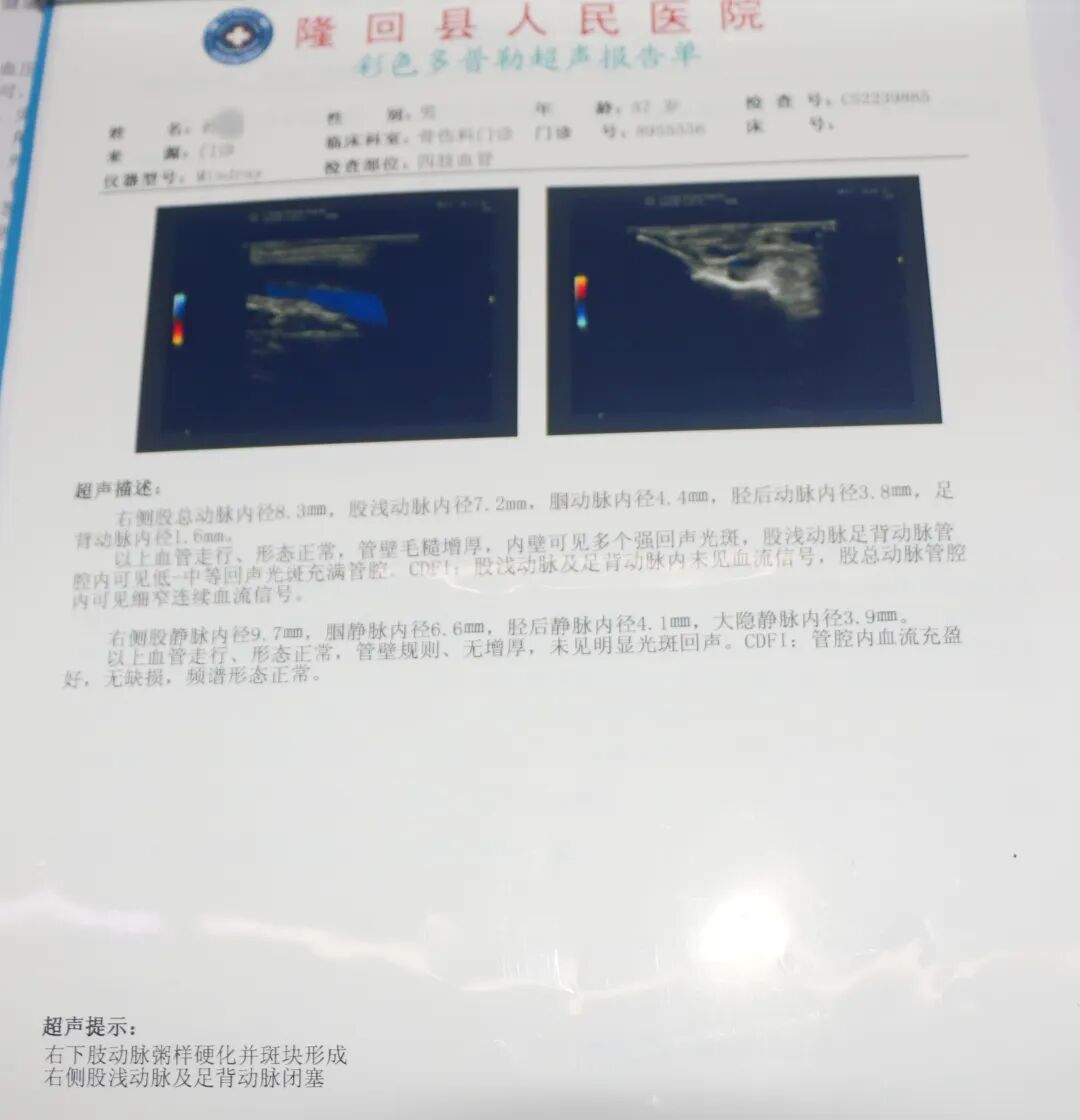 什么是外周支架效果立竿见影！点赞我院胃肠血管外科首例“外周动脉支架植入术”_https://www.jmylbn.com_新闻资讯_第3张