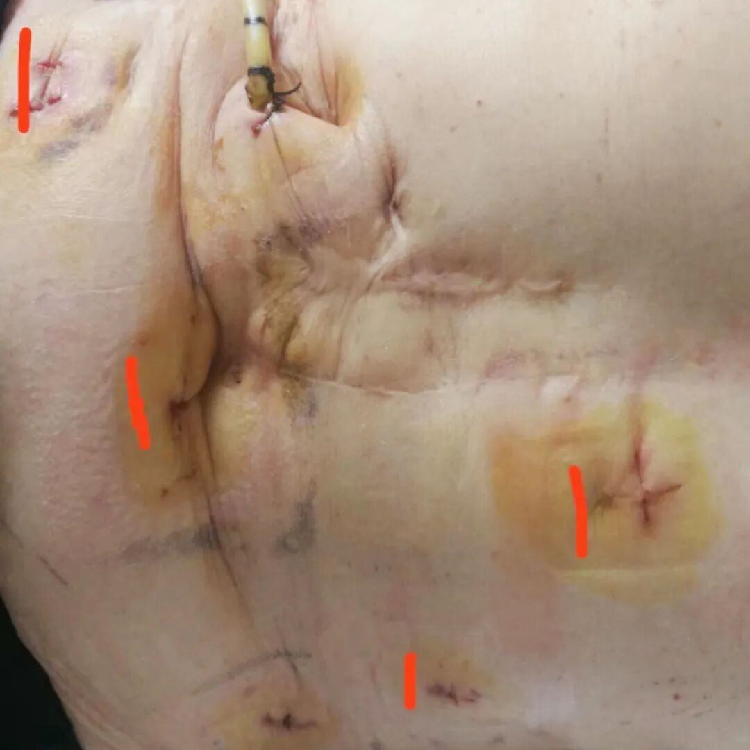 开刀孔怎么开刀既往20年3次开刀手术，盲人患者饱受肝胆结石之苦，再次手术几个微创钥匙孔解决大问题_https://www.jmylbn.com_新闻资讯_第6张