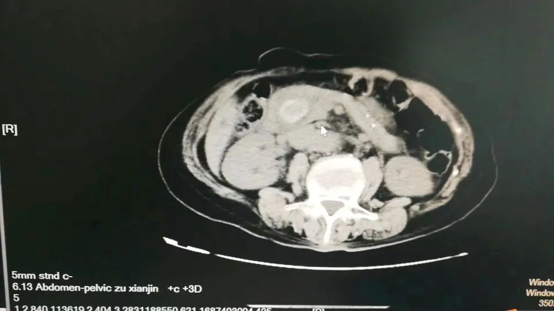 开刀孔怎么开刀既往20年3次开刀手术，盲人患者饱受肝胆结石之苦，再次手术几个微创钥匙孔解决大问题_https://www.jmylbn.com_新闻资讯_第3张