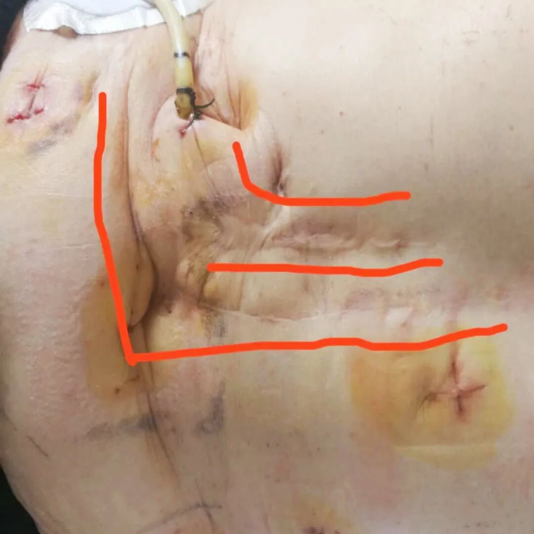 开刀孔怎么开刀既往20年3次开刀手术，盲人患者饱受肝胆结石之苦，再次手术几个微创钥匙孔解决大问题_https://www.jmylbn.com_新闻资讯_第5张