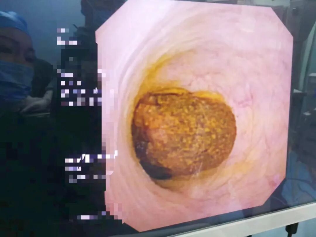 开刀孔怎么开刀既往20年3次开刀手术，盲人患者饱受肝胆结石之苦，再次手术几个微创钥匙孔解决大问题_https://www.jmylbn.com_新闻资讯_第2张