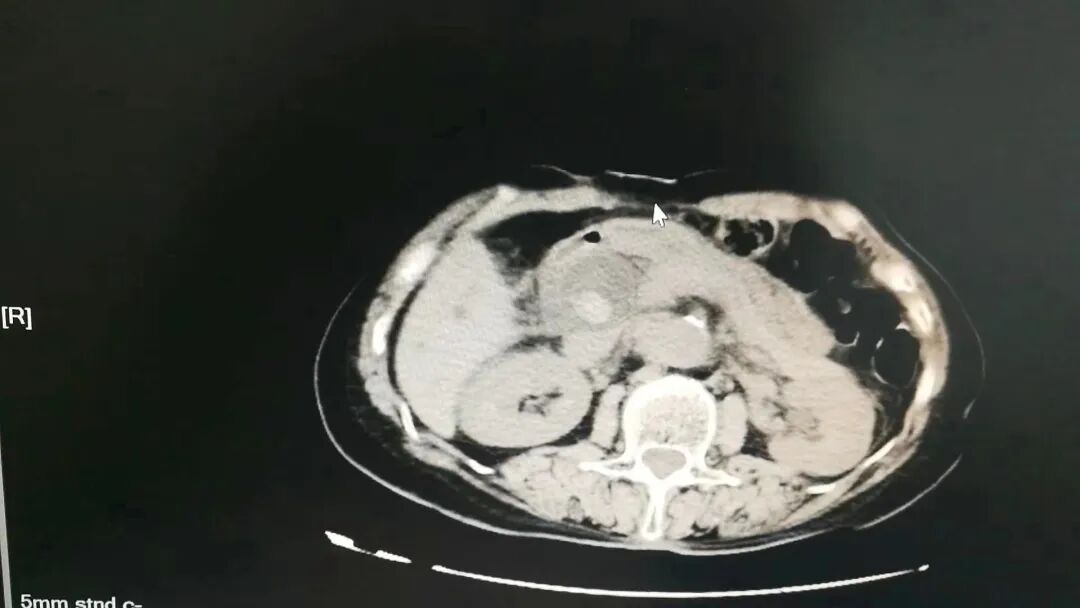 开刀孔怎么开刀既往20年3次开刀手术，盲人患者饱受肝胆结石之苦，再次手术几个微创钥匙孔解决大问题_https://www.jmylbn.com_新闻资讯_第4张