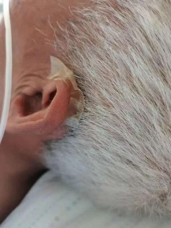 吸氧管怎么戴图解吸氧面罩戴久了脸疼怎么办？这位建医美小护有方法！超实用_https://www.jmylbn.com_新闻资讯_第11张