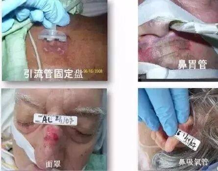 吸氧管怎么戴图解吸氧面罩戴久了脸疼怎么办？这位建医美小护有方法！超实用_https://www.jmylbn.com_新闻资讯_第8张