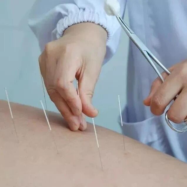 历史性突破！针灸研究登上Nature：哈佛团队找出刺激穴位治疗疾病背后原理