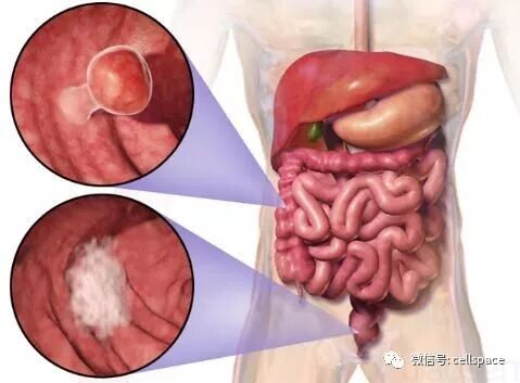 結直腸癌的發生為何越來越年輕化？ 健康 第4張