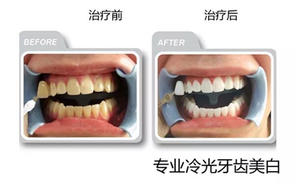 为什么牙医不用开口器刷屏朋友圈的冷光美牙仪，背后隐藏的风险你了解吗？_https://www.jmylbn.com_新闻资讯_第12张