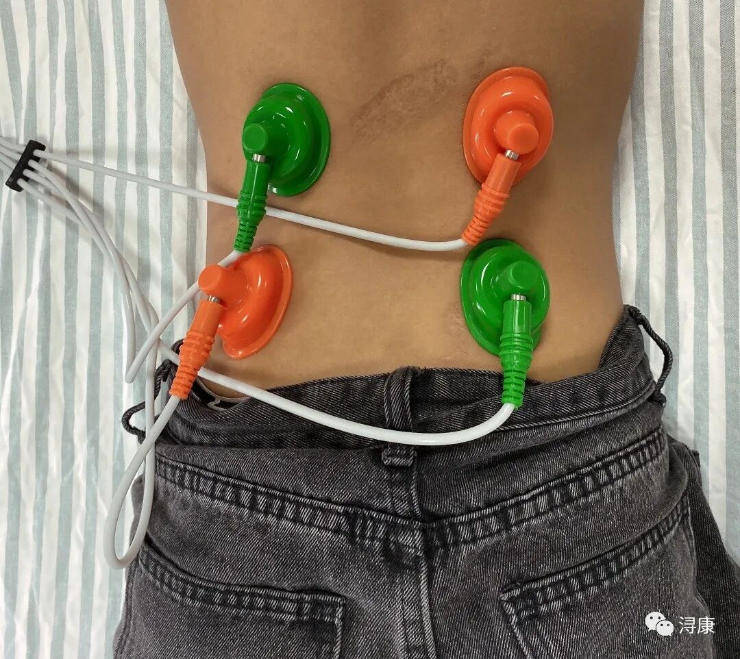 中频为什么能镇痛疼痛克星，解痉神器——中频干扰电_https://www.jmylbn.com_新闻资讯_第7张