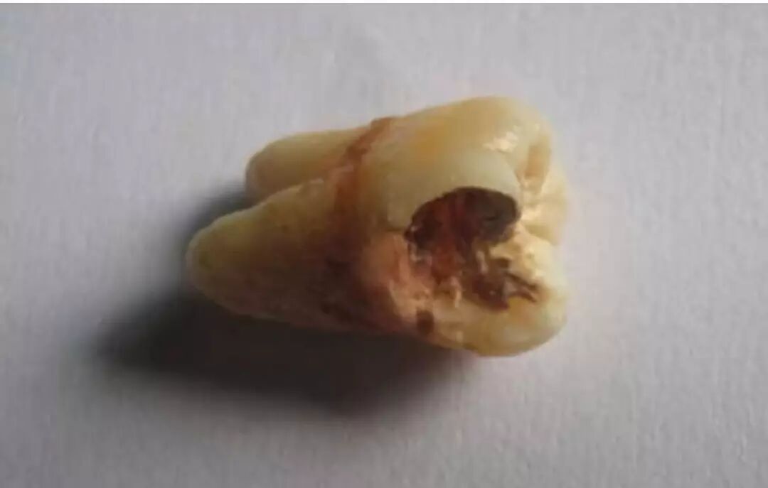 拔智齿真是花钱不讨好的事吗 南宁牙博士口腔正恒门诊部 微信公众号文章阅读 Wemp