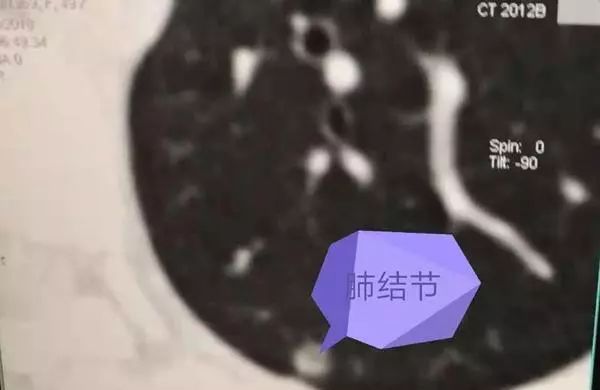 肺部结节 肺部结节