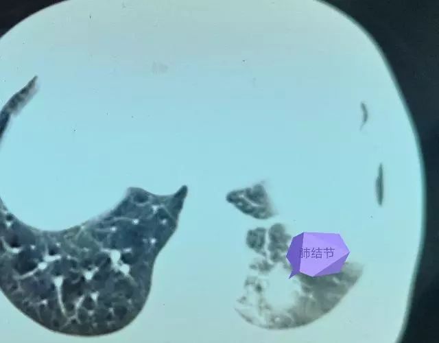 肺部结节 肺部结节