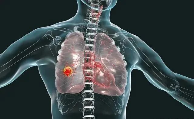 肺部结节 肺部结节