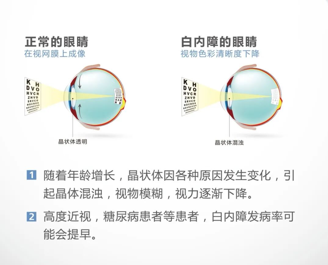 西安华厦眼科医院|高端晶体让眼睛重返年轻态！清晰&ldquo;视界&rdquo;如此简单！