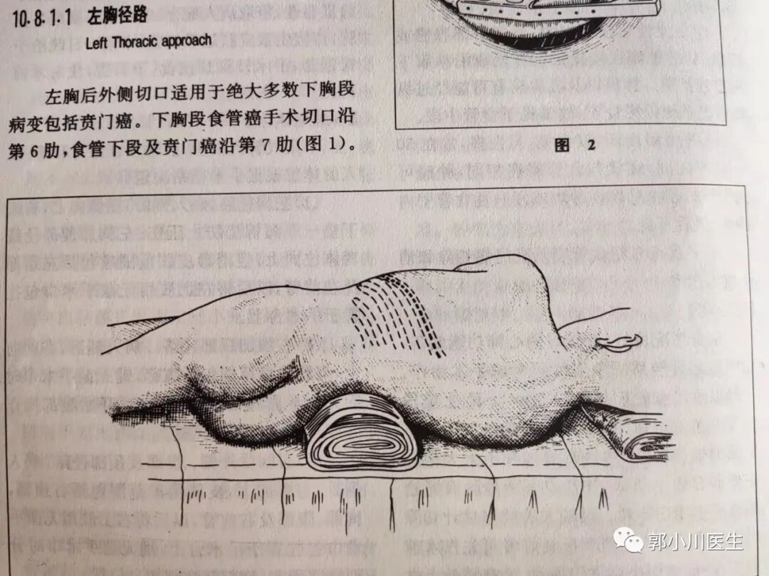 双切口是什么意思