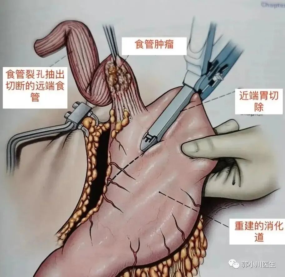 双切口是什么意思