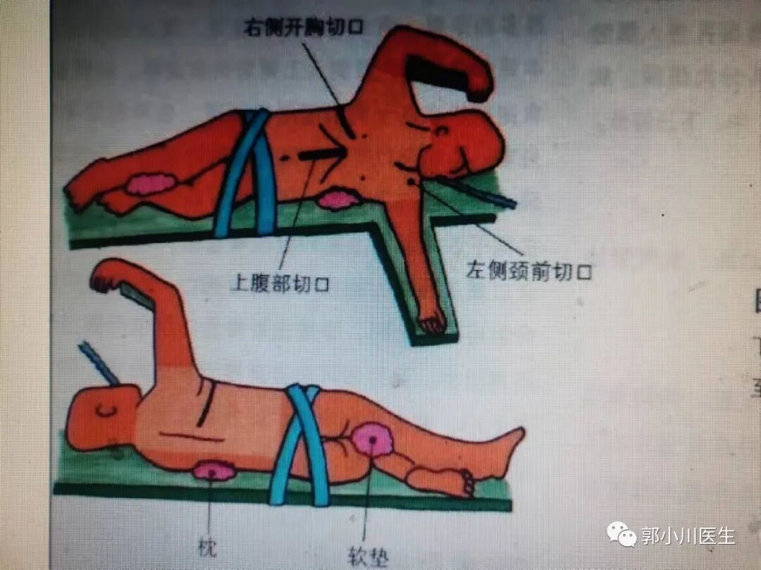 双切口是什么意思
