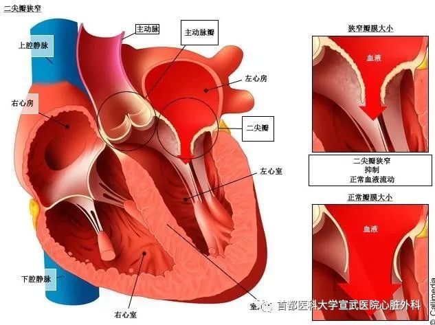 知识科普｜心脏瓣膜病的手术时机