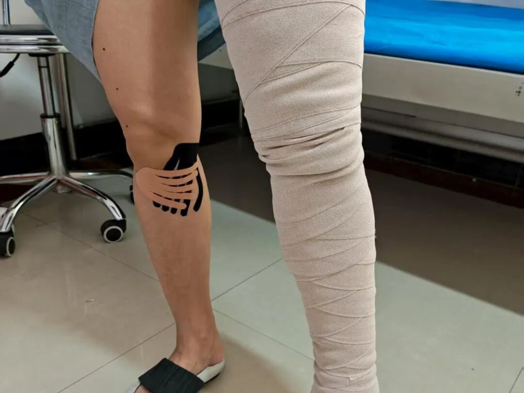 压力绷带为什么那么贵九师医院创新压力疗法 助淋巴水肿患者告别“沉重步履”_https://www.jmylbn.com_新闻资讯_第4张