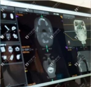 口腔ct怎么看口腔中的小牙片／全景片／头颅侧位片／CT区别以及分别看什么_https://www.jmylbn.com_新闻资讯_第7张