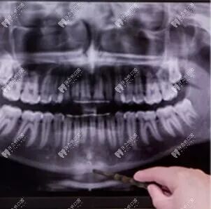 口腔ct怎么看口腔中的小牙片／全景片／头颅侧位片／CT区别以及分别看什么_https://www.jmylbn.com_新闻资讯_第5张