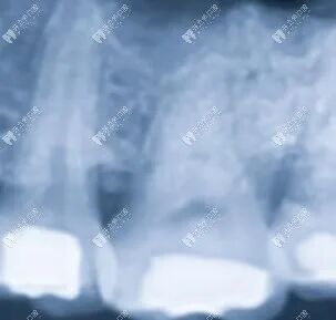 口腔ct怎么看口腔中的小牙片／全景片／头颅侧位片／CT区别以及分别看什么_https://www.jmylbn.com_新闻资讯_第4张