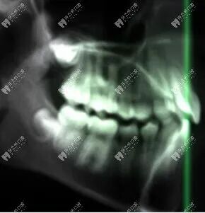 口腔ct怎么看口腔中的小牙片／全景片／头颅侧位片／CT区别以及分别看什么_https://www.jmylbn.com_新闻资讯_第6张