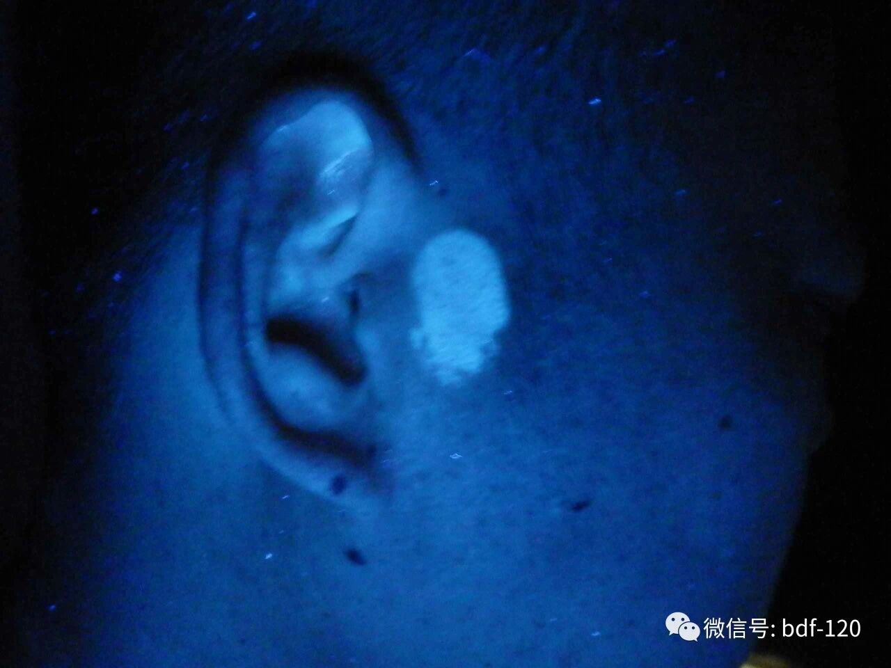 做好这4个方面，可以让白癜风治疗效果更快更好！