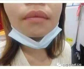 下巴白斑治疗两个多月，总体恢复了90%以上