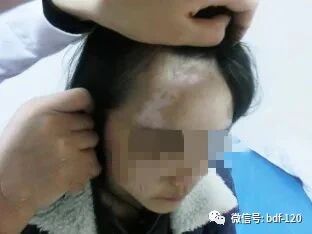 【经验】额头白斑，我终于战胜了它！