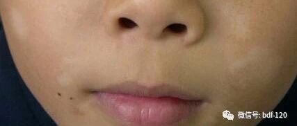 早期白癜风的症状有哪些