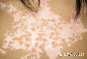 个人总结的一些白癜风发病规律，供大家参考。