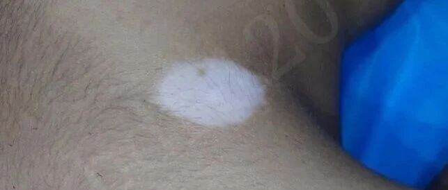 宝贝儿子后颈出现白癜风，三个月治疗基本痊愈