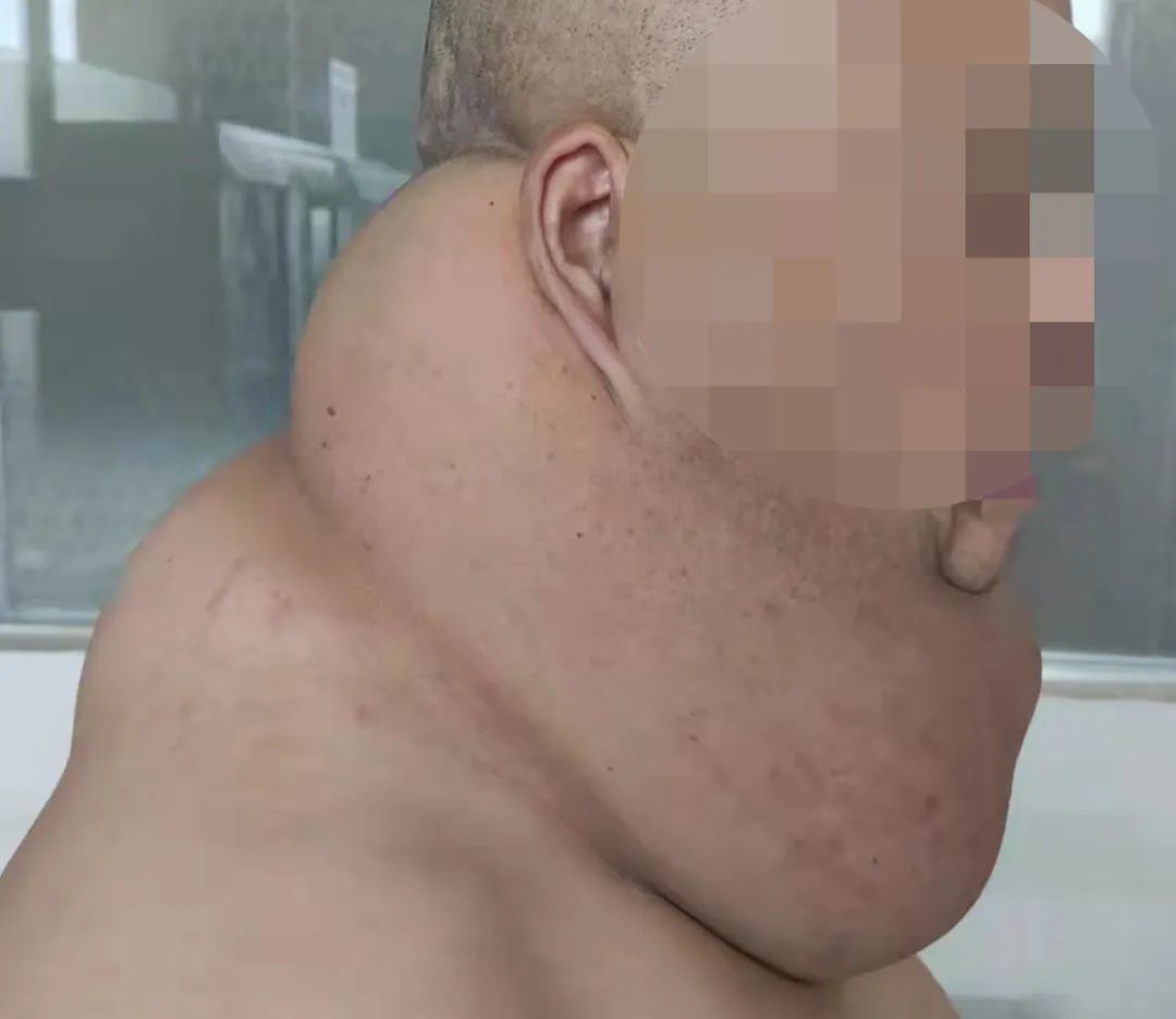 白酒红酒啤酒来者不拒，连喝30多年！漳州一大叔患罕见马德龙病