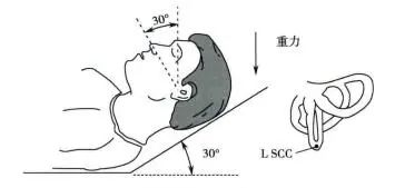 前庭专题 | 2个方法帮你辨别前庭疾病