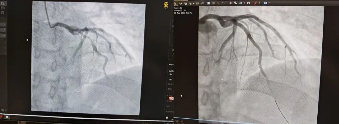 Parkway Shanghai Coronary Intervention for German Patient with 90% Stenosis