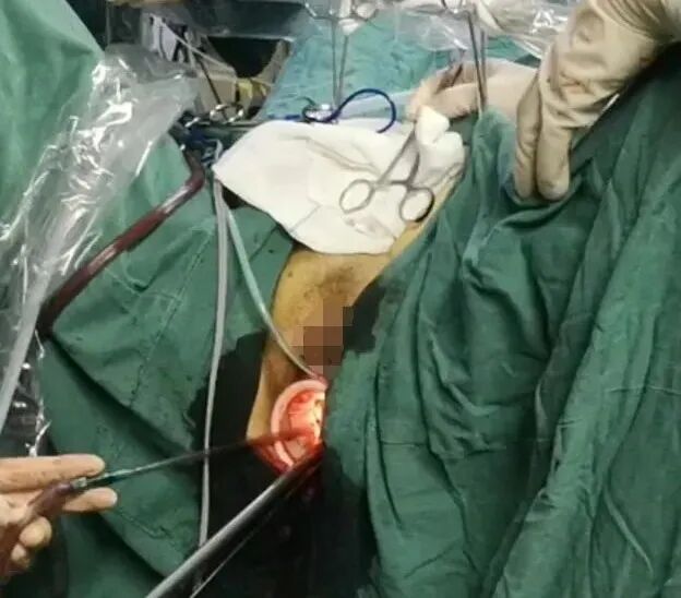 为什么不用切口保护套龚瑶专栏 ｜ 切口保护套在腹腔镜术中的 5 大妙用_https://www.jmylbn.com_新闻资讯_第6张